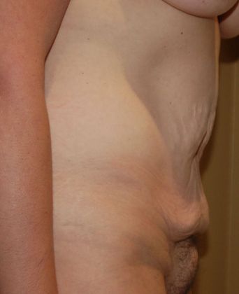 Mommy Makeover: Case 73 - Before