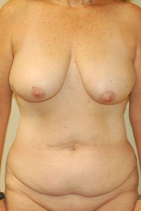 Mommy Makeover Case 74 - Before