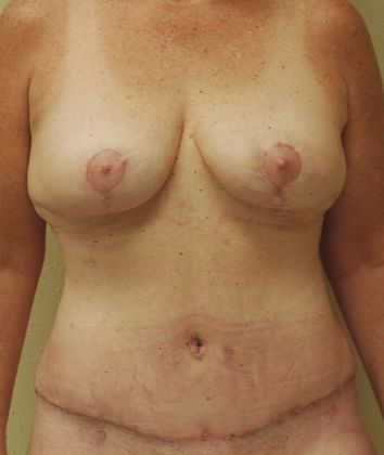 Mommy Makeover Case 74 - After