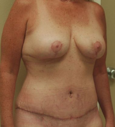 Mommy Makeover: Case 74 - After