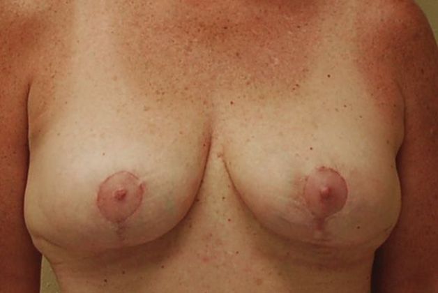 Breast Lift (Mastopexy) Case 41 - After