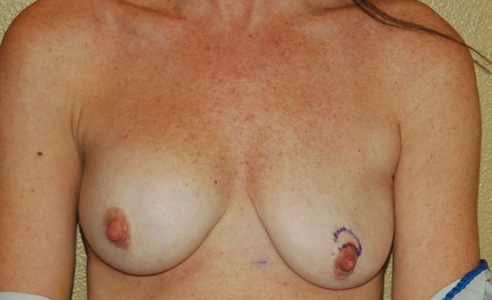 Breast Revision: Case 62 - Before