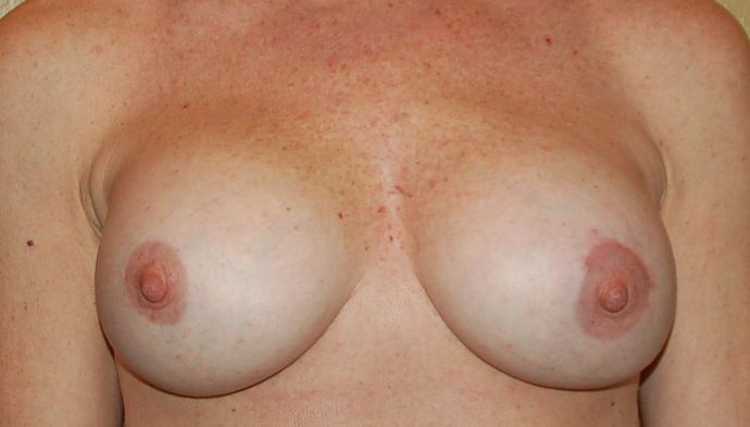 Breast Revision: Case 62 - After