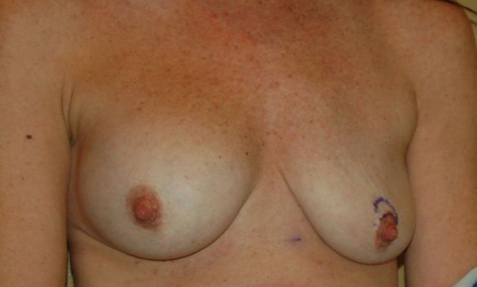 Breast Revision: Case 62 - Before