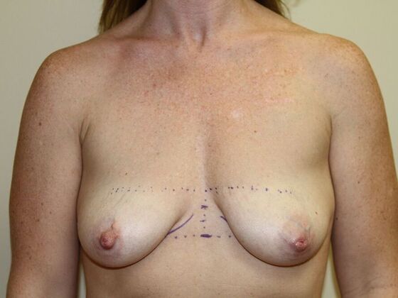 Breast Lift & Implants Case 1 - Before