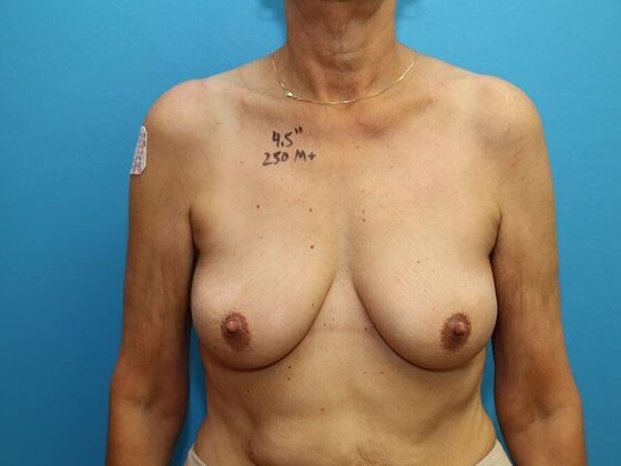 Breast Lift & Implants: Case 2 - Before
