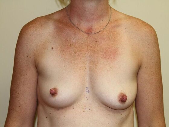 Breast Augmentation: Case 6 - Before