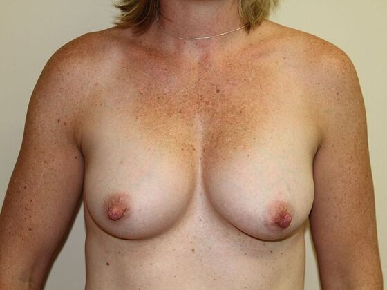 Breast Augmentation: Case 6 - After
