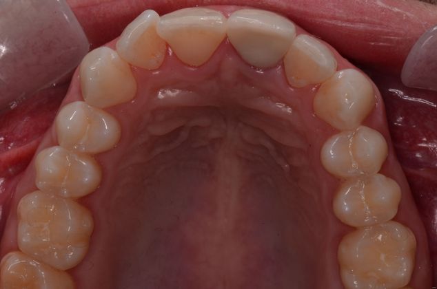 Invisalign Cases