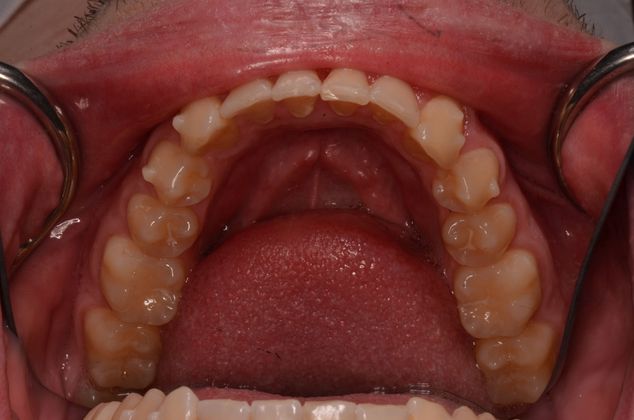 Invisalign: Case 2 - Lower teeth after invisalign