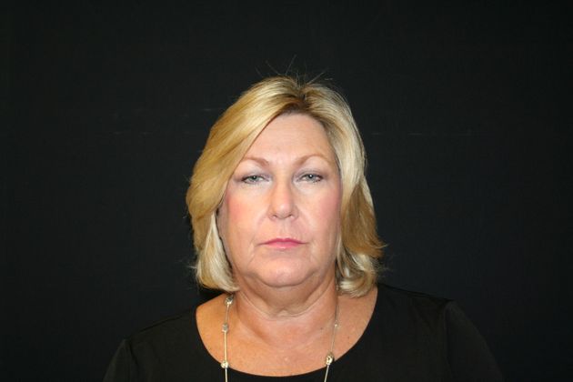 Facelift Case 12 - Before