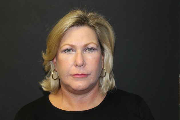 Facelift Case 12 - After