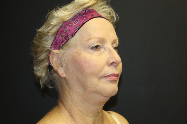 Facelift Case 13 - Before