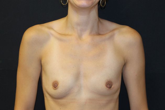 Breast Augmentation Case 15 - Before