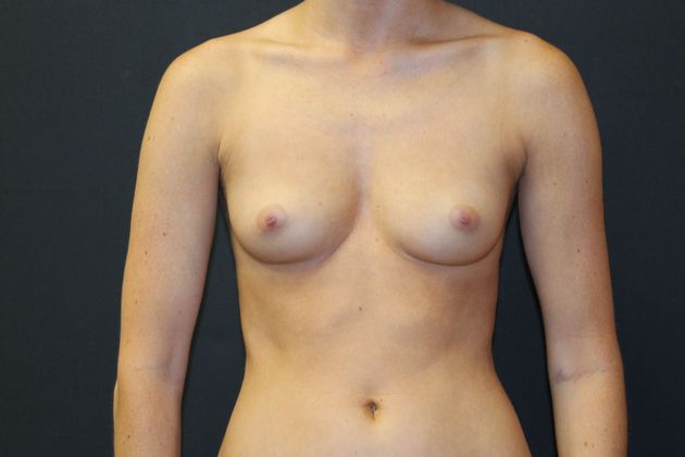 Breast Augmentation Case 17 - Before