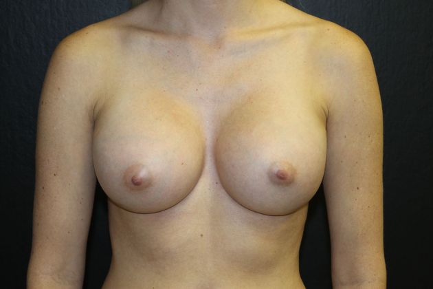 Breast Augmentation Case 17 - After