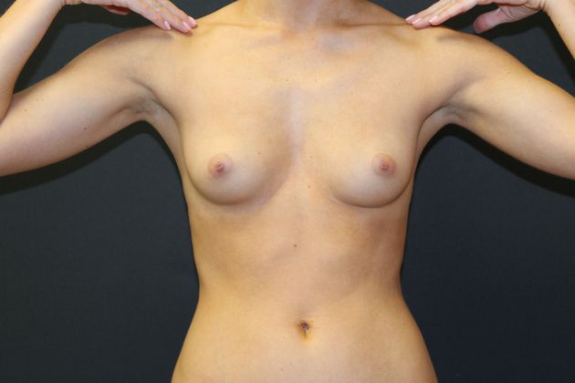 Breast Augmentation: Case 17 - Before 