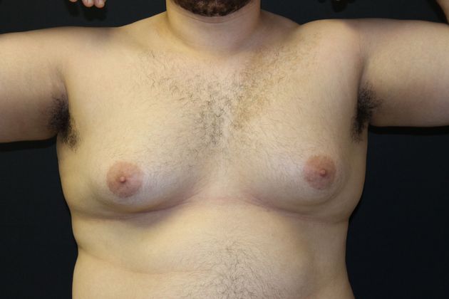Gynecomastia Case 1 - Before