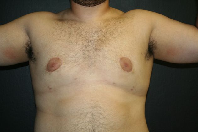 Gynecomastia Case 1 - After