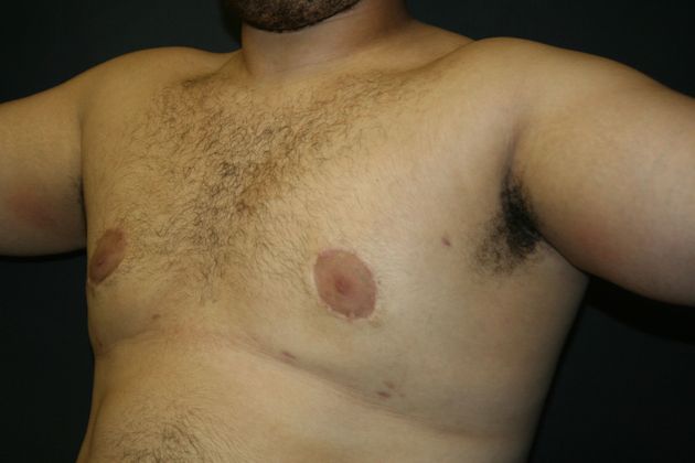 Gynecomastia: Case 1 - After