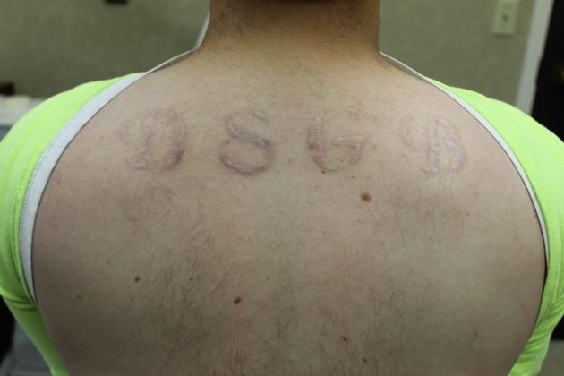 Laser Tattoo Removal  Case 3 - Before