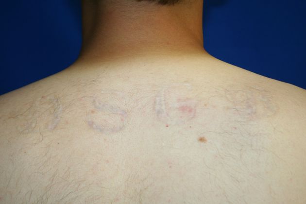 Laser Tattoo Removal  Case 3 - After