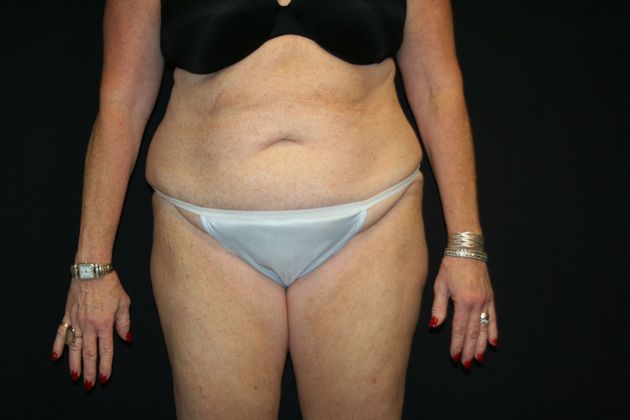 Abdominoplasty Case 11 - Before