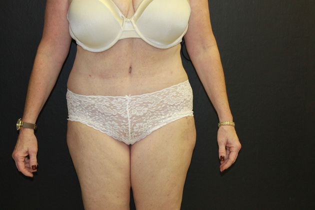 Abdominoplasty Case 11 - After