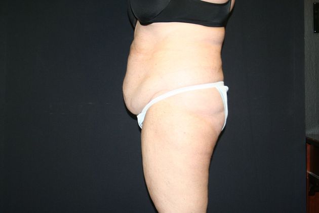 Abdominoplasty: Case 11 - Before 