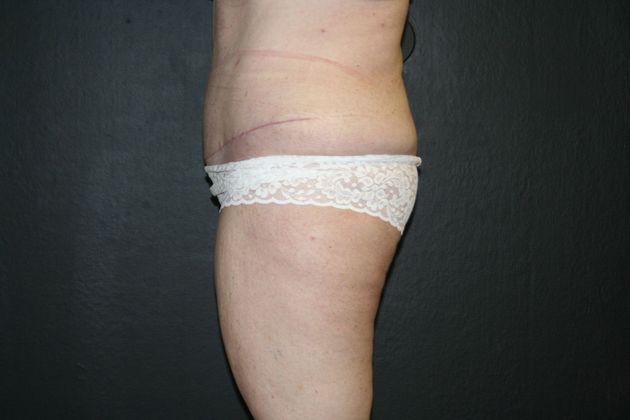 Abdominoplasty: Case 11 - After