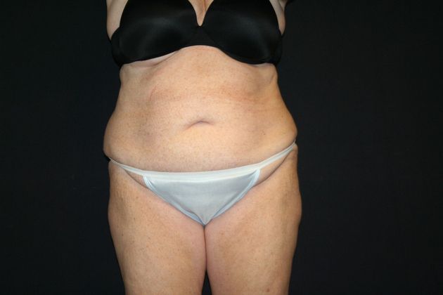 Abdominoplasty: Case 11 - Before 