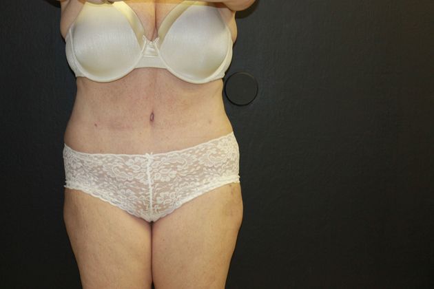 Abdominoplasty: Case 11 - After