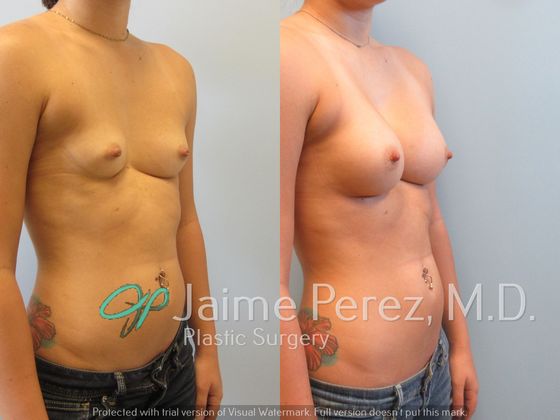 🥇 Will Breast Augmentation surgery help with Pigeon Chest Deformity?