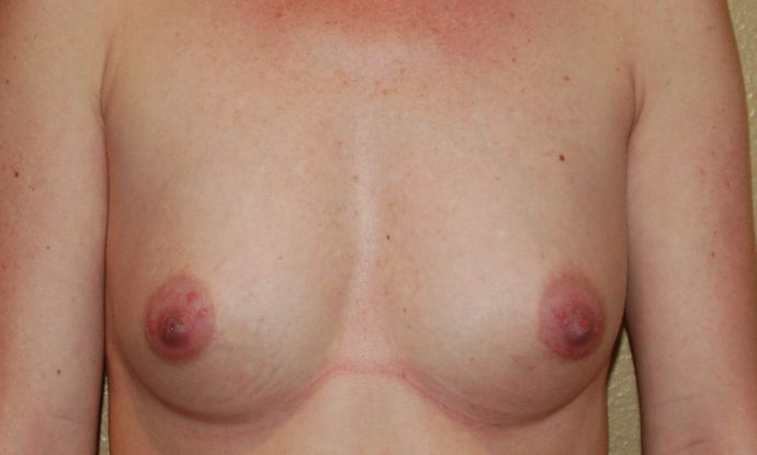 Breast Augmentation Case 375 - Before