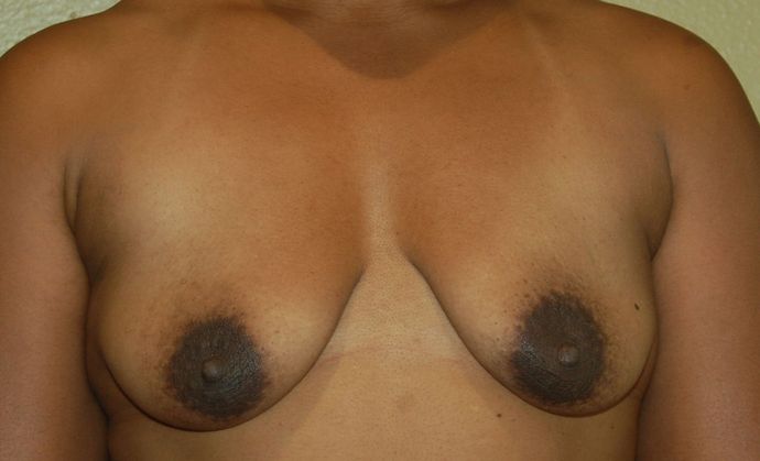 Breast Augmentation w/ Lift: Case 173 - Before