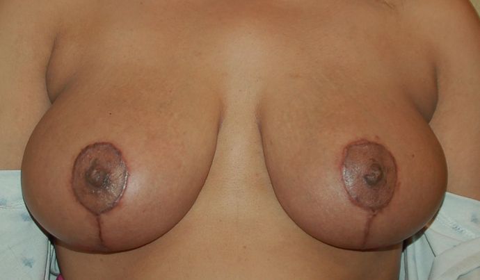Breast Lift (Mastopexy) Case 42 - After