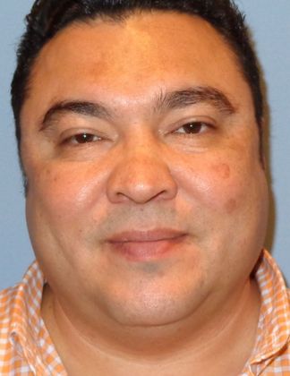 Kybella for Double Chin: Case 1 - After Kybella