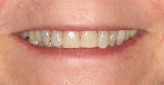 Full Mouth Reconstruction: Case 15 - before