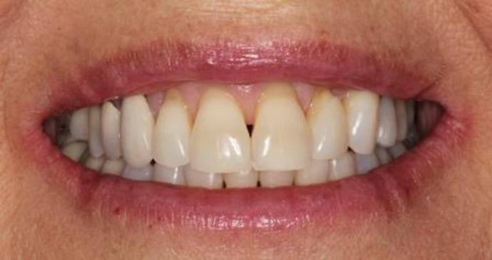 Invisalign Case 10 - After