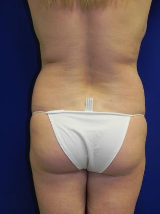 Body Tummy Tuck / Abdominoplasty: Case 12 (18329) - Before