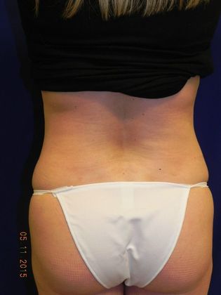 Body Tummy Tuck / Abdominoplasty: Case 12 (18329) - After