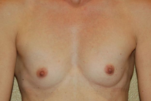 Breast Augmentation Case 378 - Before