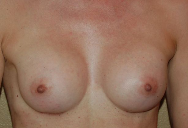 Breast Augmentation Case 378 - After