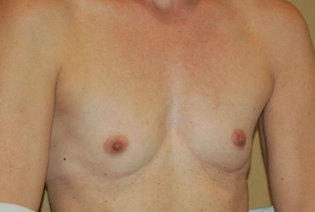 Breast Augmentation: Case 378 - Before