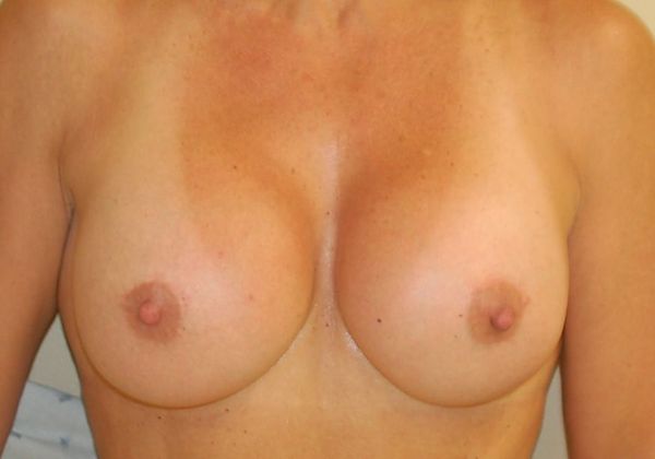 Breast Augmentation Case 379 - After