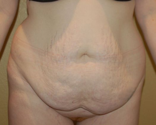 Massive Weight Loss : Case 29 - Before