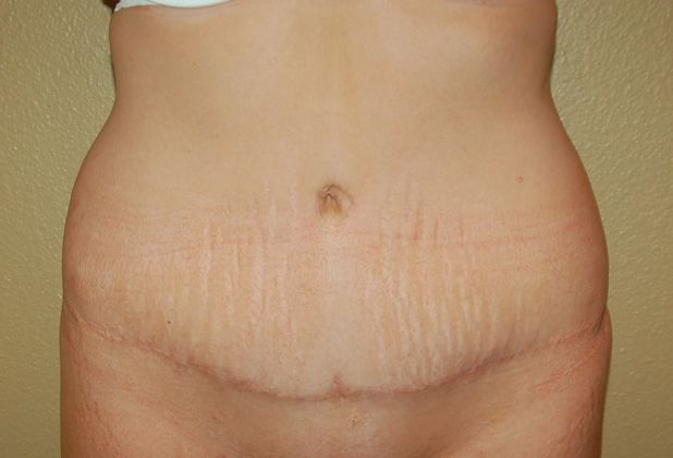 Massive Weight Loss : Case 29 - After