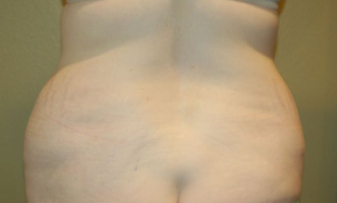 Buttock Lift Case 5 - Before