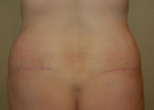 Buttock Lift Case 5 - After