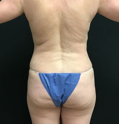 Mommy Makeover: Case 29 Mommy Makeover - After